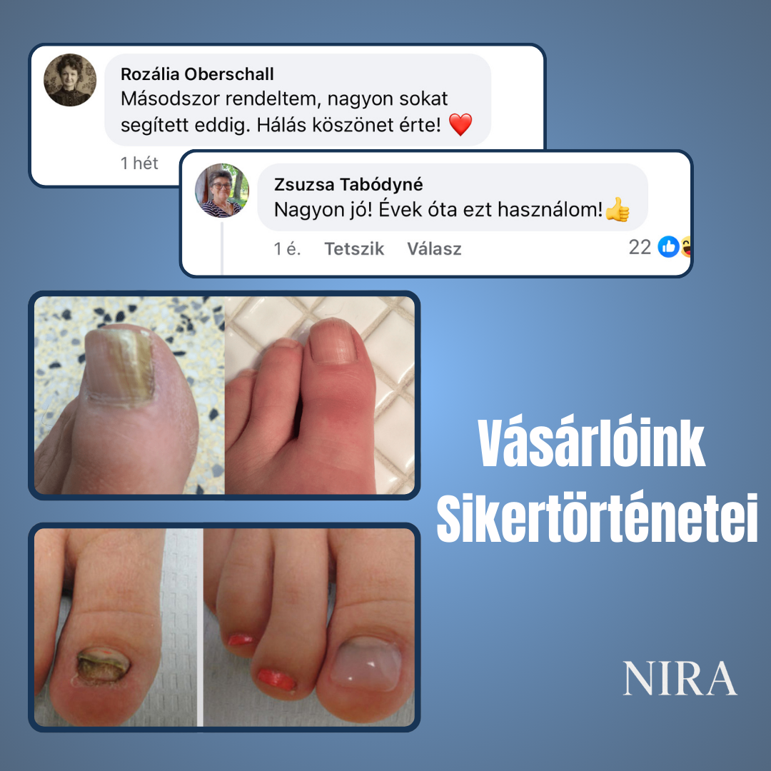 NIRA Éjszakai Tapasz Gombás Körömre (Természetes megoldás körömgombára)